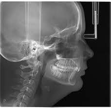 Cephalometric X-Rays