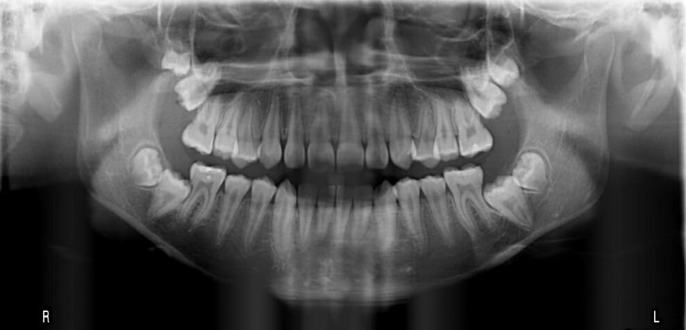 Panoramic X-Rays