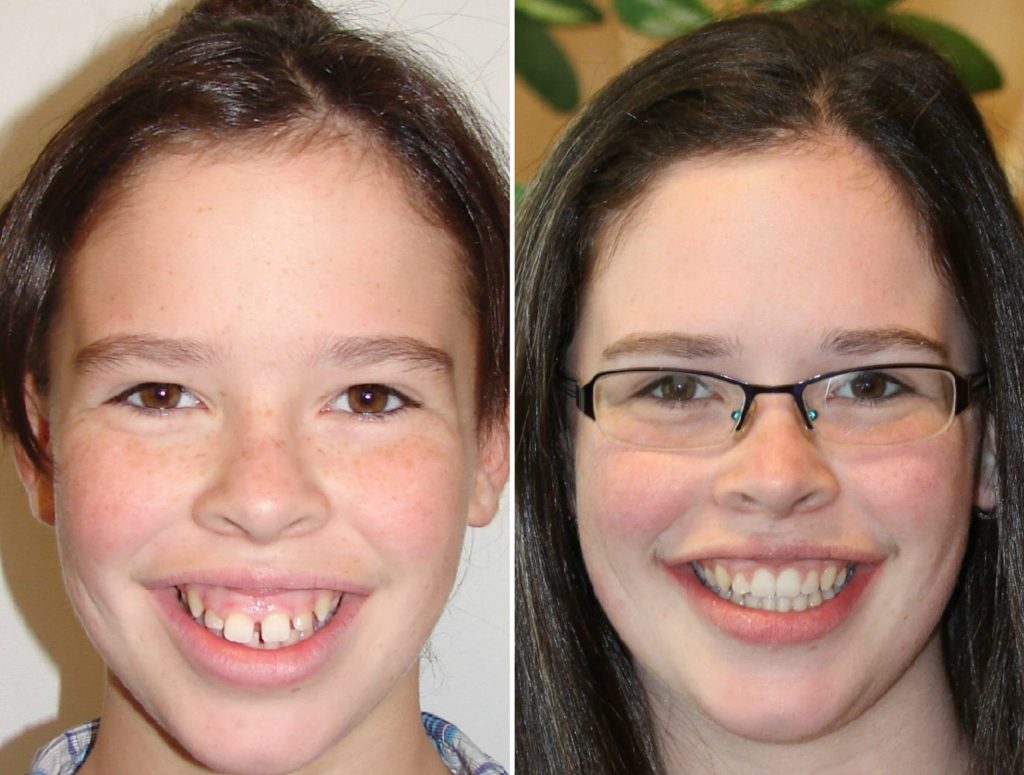 Braces In London Ontario - Dental Braces and Oral Braces For The Best Price In Town braces web image
